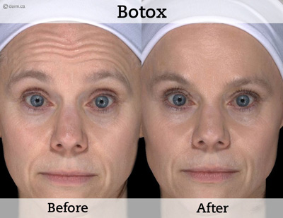 botox-before-after-small